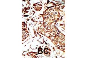 Formalin-fixed and paraffin-embedded human cancer tissue reacted with BRD3 polyclonal antibody  , which was peroxidase-conjugated to the secondary antibody, followed by AEC staining. (BRD3 antibody  (C-Term))