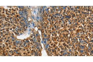 Immunohistochemistry of paraffin-embedded Human liver cancer tissue using ADCY4 Polyclonal Antibody at dilution 1:45 (ADCY4 antibody)