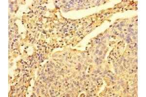 Immunohistochemistry of paraffin-embedded human cervical cancer using ABIN7175093 at dilution of 1:100 (UPRT antibody  (AA 1-309))