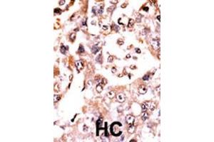 Formalin-fixed and paraffin-embedded human cancer tissue reacted with the primary antibody, which was peroxidase-conjugated to the secondary antibody, followed by AEC staining. (Dual Specificity Phosphatase 3 (DUSP3) (AA 1-30), (N-Term) antibody)