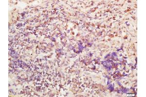 Formalin-fixed and paraffin embedded human lung carcinoma labeled with Anti-BTBD7 Polyclonal Antibody, Unconjugated  at 1:200 followed by conjugation to the secondary antibody and DAB staining (BTBD7 antibody  (AA 41-130))