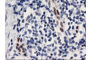 Immunohistochemical staining of paraffin-embedded Adenocarcinoma of Human breast tissue using anti-ELK3 mouse monoclonal antibody. (ELK3 antibody)
