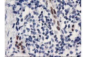 Immunohistochemical staining of paraffin-embedded Adenocarcinoma of Human breast tissue using anti-ELK3 mouse monoclonal antibody.