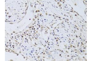 Immunohistochemistry of paraffin-embedded human gastric cancer using FKBP4 Antibody (ABIN5973289) at dilution of 1/100 (40x lens). (FKBP4 antibody)