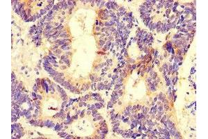 Immunohistochemistry of paraffin-embedded human colon cancer using ABIN7164372 at dilution of 1:100 (DDX6 antibody  (AA 1-149))