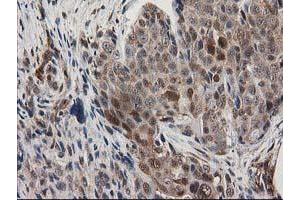 Immunohistochemical staining of paraffin-embedded Adenocarcinoma of Human breast tissue using anti-MAPRE2 mouse monoclonal antibody. (MAPRE2 antibody)