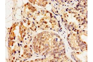 Immunohistochemistry of paraffin-embedded human prostate cancer using ABIN7154893 at dilution of 1:100 (HSF2 antibody  (AA 79-173))