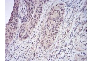 Immunohistochemical analysis of paraffin-embedded human cervical cancer tissues using HDAC2 mouse mAb with DAB staining. (HDAC2 antibody  (AA 217-327))
