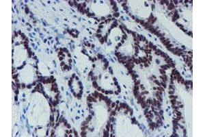 Immunohistochemical staining of paraffin-embedded Adenocarcinoma of Human colon tissue using anti-METT10D mouse monoclonal antibody. (METTL16 antibody)