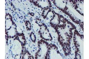 Immunohistochemical staining of paraffin-embedded Adenocarcinoma of Human colon tissue using anti-METT10D mouse monoclonal antibody.