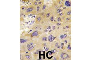 Formalin-fixed and paraffin-embedded human hepatocellular carcinoma reacted with PFKFB1 polyclonal antibody  , which was peroxidase-conjugated to the secondary antibody, followed by DAB staining. (PFKFB1 antibody  (N-Term))