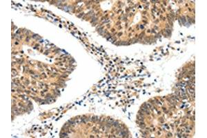 The image on the left is immunohistochemistry of paraffin-embedded Human colon cancer tissue using ABIN7192661(SSTR5 Antibody) at dilution 1/30, on the right is treated with synthetic peptide. (SSTR5 antibody)