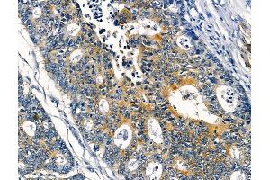ABIN6256861 and ABIN6273953 at 1/100 staining human prostate cancer and adjacent non-tumor tissue by IHC-P. (NPY4R antibody  (N-Term))