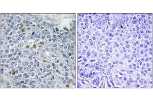 Immunohistochemistry analysis of paraffin-embedded human breast carcinoma, using TOP2A (Phospho-Ser1106) Antibody. (Topoisomerase II alpha antibody  (pSer1106))