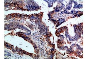 Immunohistochemical analysis of paraffin-embedded human-colon-cancer, antibody was diluted at 1:200