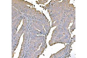 IHC analysis of PKM2 using anti-PKM2 antibody (ABIN7603151). (PKM antibody  (N-Term))