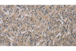 Immunohistochemistry of paraffin-embedded Human gastric cancer tissue using DCN Polyclonal Antibody at dilution 1:30 (Decorin antibody)