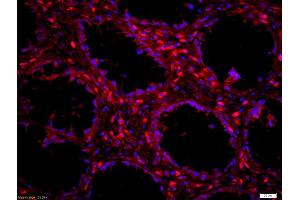 Formalin-fixed and paraffin embedded human colon carcinoma labeled with Anti-LSP1 Polyclonal Antibody, Unconjugated (ABIN755632) at 1:200 followed by conjugation to the secondary antibody Goat Anti-Rabbit IgG,PE conjugated used at 1:200 dilution for 40 minutes at 37°C and DAPI staining (LSP1 antibody  (AA 241-339))