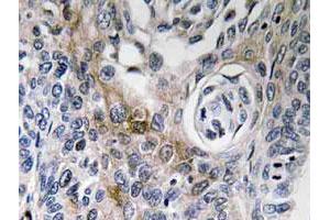Immunohistochemical analysis of paraffin-embedded human lung cancer tissue using CD63 polyclonal antibody . (CD63 antibody)