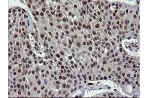 Immunohistochemical staining of paraffin-embedded Carcinoma of Human lung tissue using anti-UBE2E3 mouse monoclonal antibody.