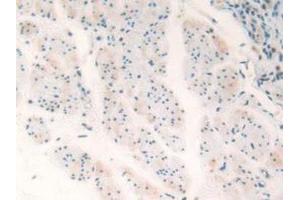 Detection of TP53TG5 in Human Esophagus Cancer Tissue using Polyclonal Antibody to TP53 Target Gene 5 (TP53TG5) (TP53TG5 antibody  (AA 190-262))