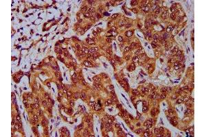 IHC image of ABIN7154731 diluted at 1:400 and staining in paraffin-embedded human liver cancer performed on a Leica BondTM system. (GNA12 antibody  (AA 112-270))