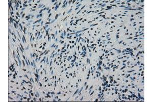 Immunohistochemical staining of paraffin-embedded Adenocarcinoma of ovary tissue using antiHSPA9mouse monoclonal antibody. (HSPA9 antibody)