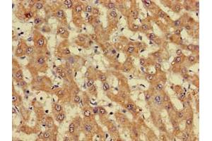Immunohistochemistry of paraffin-embedded human liver cancer using ABIN7162738 at dilution of 1:100 (GIPC1 antibody  (AA 7-74))