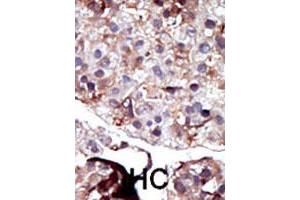 Formalin-fixed and paraffin-embedded human hepatocellular carcinoma tissue reacted with SPHK2 polyclonal antibody  , which was peroxidase-conjugated to the secondary antibody, followed by AEC staining. (SPHK2 antibody  (N-Term))