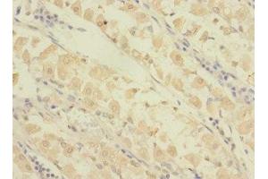 Immunohistochemistry of paraffin-embedded human gastric cancer using ABIN7154384 at dilution of 1:100