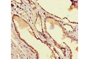 Immunohistochemistry of paraffin-embedded human prostate cancer using ABIN7172691 at dilution of 1:100 (TAF6 antibody  (AA 627-677))