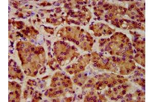 IHC image of ABIN7151354 diluted at 1:1000 and staining in paraffin-embedded human pancreatic cancer performed on a Leica BondTM system. (ART5 antibody  (AA 45-291))