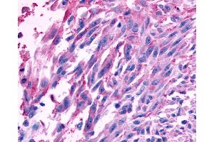 Anti-FZD10 / Frizzled 10 antibody IHC of human Skin, Melanoma. (FZD10 antibody  (N-Term))