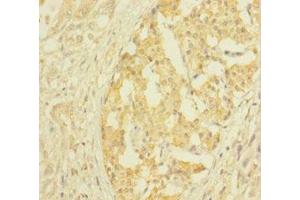 Immunohistochemistry of paraffin-embedded human pancreatic cancer using ABIN7147859 at dilution of 1:100 (CLTB antibody  (AA 1-211))