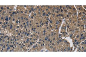 Immunohistochemistry of paraffin-embedded Human liver cancer using SIGMAR1 Polyclonal Antibody at dilution of 1:50 (SIGMAR1 antibody)