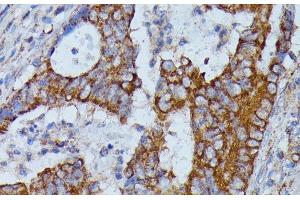 Immunohistochemistry of paraffin-embedded Human colon carcinoma using HMGCS2 Polyclonal Antibody at dilution of 1:100 (40x lens). (HMGCS2 antibody)