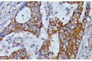Immunohistochemistry of paraffin-embedded Human colon carcinoma using HMGCS2 Polyclonal Antibody at dilution of 1:100 (40x lens).