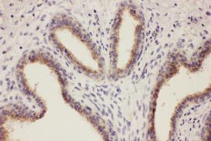 Anti-RTN3 antibody, IHC(P) IHC(P): Human Mammary Cancer Tissue (Reticulon 3 antibody  (C-Term))