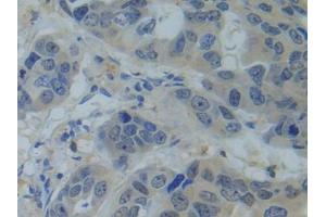 IHC-P analysis of Human Breast cancer Tissue, with DAB staining. (SNRPC antibody  (AA 2-159))
