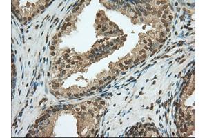 Immunohistochemical staining of paraffin-embedded Adenocarcinoma of Human ovary tissue using anti-PDE4A mouse monoclonal antibody.
