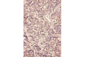 Anti-FGF19 antibody, IHC(P) IHC(P): Human Gallbladder Cancer Tissue (FGF19 antibody  (Middle Region))