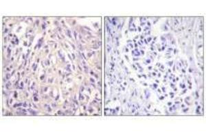 Immunohistochemistry analysis of paraffin-embedded human breast carcinoma tissue using UBE1L antibody.