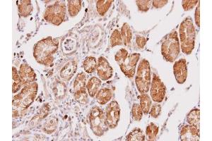 IHC-P Image Immunohistochemical analysis of paraffin-embedded human gastric cancer, using Cathepsin O, antibody at 1:100 dilution. (CTSO antibody)