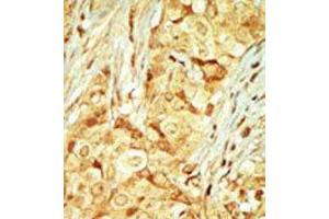 Formalin-fixed and paraffin-embedded human cancer tissue reacted with the primary antibody, which was peroxidase-conjugated to the secondary antibody, followed by DAB staining. (RAGE antibody  (C-Term))