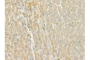 ABIN6266258 and ABIN6277419 at 1/100 staining human hepatocellular carcinoma by IHC-P. (P2RY11 antibody  (C-Term))