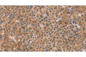 Immunohistochemistry of paraffin-embedded Human liver cancer using CDK11B Polyclonal Antibody at dilution of 1:40 (CDK11 antibody)