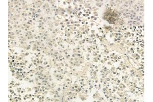 ABIN6260386 and ABIN6279208 at 1/100 staining human pituitary adenoma by IHC-P.