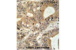 ABCC3 antibody (Center) immunohistochemistry analysis in formalin fixed and paraffin embedded human colon carcinoma followed by peroxidase conjugation of the secondary antibody and DAB staining. (ABCC3 antibody  (Middle Region))