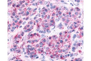 Anti-AVPR2 / V2R antibody IHC of human Breast, Carcinoma.