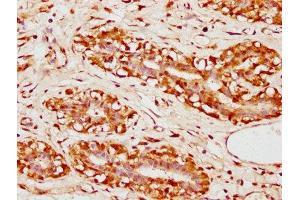 IHC image of ABIN7152644 diluted at 1:300 and staining in paraffin-embedded human breast cancer performed on a Leica BondTM system. (FAR1 antibody  (AA 182-343))